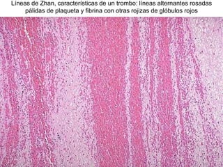 Líneas de Zhan, características de un trombo: líneas alternantes rosadas
pálidas de plaqueta y fibrina con otras rojizas de glóbulos rojos
 