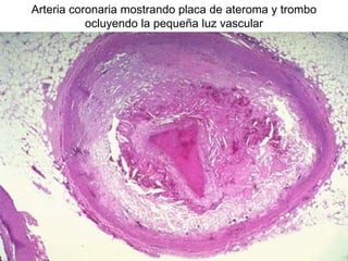 Arteria coronaria mostrando placa de ateroma y trombo
ocluyendo la pequeña luz vascular
 