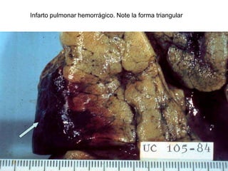 Infarto pulmonar hemorrágico. Note la forma triangular
 