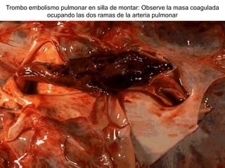 Trombo embolismo pulmonar en silla de montar: Observe la masa coagulada
ocupando las dos ramas de la arteria pulmonar
 