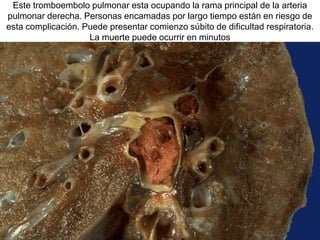 Este tromboembolo pulmonar esta ocupando la rama principal de la arteria
pulmonar derecha. Personas encamadas por largo tiempo están en riesgo de
esta complicación. Puede presentar comienzo súbito de dificultad respiratoria.
La muerte puede ocurrir en minutos
 