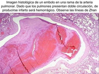 Imagen histológica de un embolo en una rama de la arteria
pulmonar. Dado que los pulmones presentan doble circulación, de
producirse infarto será hemorrágico. Observe las líneas de Zhan
 