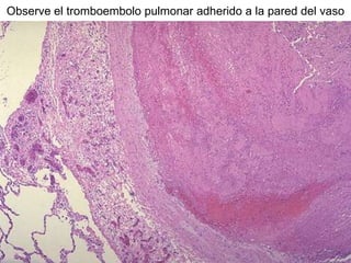 Observe el tromboembolo pulmonar adherido a la pared del vaso
 