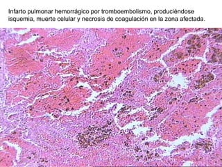 Infarto pulmonar hemorrágico por tromboembolismo, produciéndose
isquemia, muerte celular y necrosis de coagulación en la zona afectada.
 