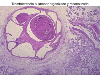 Tromboembolo pulmonar organizado y recanalizado
 