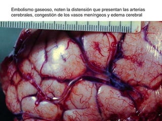 Embolismo gaseoso, noten la distensión que presentan las arterias
cerebrales, congestión de los vasos meníngeos y edema cerebral
 