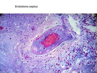 Embolismo septico
 