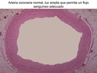 Arteria coronaria normal, luz amplia que permite un flujo
sanguíneo adecuado
 