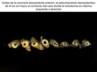 Cortes de la coronaria descendente anterior: el estrechamiento aterosclerotico
de la luz es mayor al comienzo del vaso donde la turbulencia es máxima
(izquierda a derecha)
 