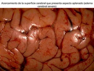 Acercamiento de la superficie cerebral que presenta aspecto aplanado (edema
cerebral severo)
 