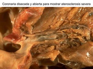 Coronaria disecada y abierta para mostrar aterosclerosis severa
 