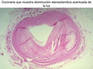 Coronaria que muestra disminución aterosclerotica acentuada de
la luz
 