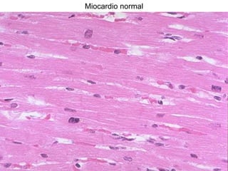 Miocardio normal
 