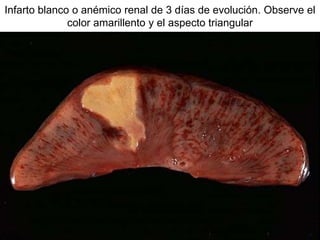 Infarto blanco o anémico renal de 3 días de evolución. Observe el
color amarillento y el aspecto triangular
 