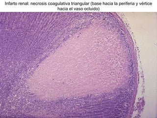 Infarto renal: necrosis coagulativa triangular (base hacia la periferia y vértice
hacia el vaso ocluido)
 