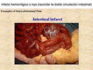 Infarto hemorrágico o rojo (recordar la doble circulación intestinal)
 