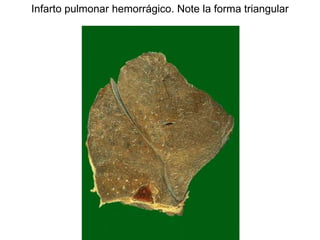 Infarto pulmonar hemorrágico. Note la forma triangular
 
