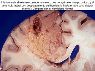 Infarto cerebral extenso con edema severo que comprime el cuerpo calloso y el
ventrículo lateral con desplazamiento del hemisferio hacia el lado contralateral
(hernia): Compare con el hemisferio normal
 