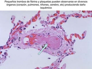 Pequeños trombos de fibrina y plaquetas pueden observarse en diversos
órganos (corazón, pulmones, riñones, cerebro, etc) produciendo daño
isquémico
 