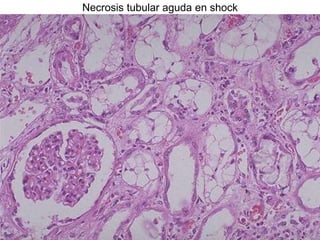 Necrosis tubular aguda en shock
 