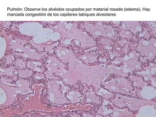 Pulmón: Observe los alvéolos ocupados por material rosado (edema). Hay
marcada congestión de los capilares tabiques alveolares
 