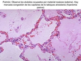 Pulmón: Observe los alvéolos ocupados por material rosáceo (edema). Hay
marcada congestión de los capilares de lo tabiques alveolares (hiperemia
pasiva)
 