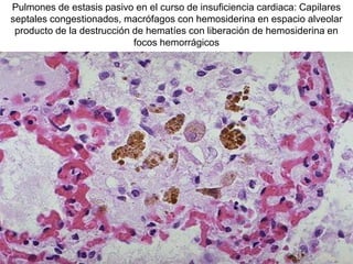 Pulmones de estasis pasivo en el curso de insuficiencia cardiaca: Capilares
septales congestionados, macrófagos con hemosiderina en espacio alveolar
producto de la destrucción de hematíes con liberación de hemosiderina en
focos hemorrágicos
 