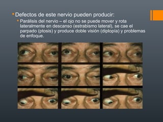 Defectos de este nervio pueden producir:
 Parálisis del nervio – el ojo no se puede mover y rota
lateralmente en descanso (estrabismo lateral), se cae el
parpado (ptosis) y produce doble visión (diplopía) y problemas
de enfoque.
 