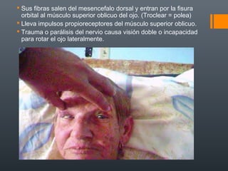  Sus fibras salen del mesencefalo dorsal y entran por la fisura
orbital al músculo superior oblicuo del ojo. (Troclear = polea)
 Lleva impulsos propioreceptores del músculo superior oblicuo.
 Trauma o parálisis del nervio causa visión doble o incapacidad
para rotar el ojo lateralmente.
 