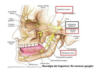 Neuralgia del trigemino: Rx remover ganglio
 