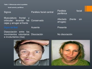 Tabla 1: Diferencias entre la parálisis
facial central y periférica
Signos Parálisis facial central
Parálisis facial
periférica
Musculatura frontal y
orbicular: levantar las
cejas y arrugar el frente
Conservado
Afectado (frente sin
arrugas)
Signo de Bell Ausente Presente
Diasociación entre los
movimientos voluntarios
e involuntarios (risa)
Disociación No disociación
 
