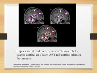• Implicación de red córtico-mesencéfalo-cerebelo-
tálamo-cortical en TE; en ART red córtico-talámica
únicamente.
Muthuraman Muthuraman, Günther Deuschl, et al. Essential and Aging-Related Tremor: Differences of Central Control.
Movement Disorders 2015, 30(12):1673-80.
 