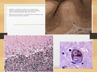 1. Matthew et al. Purkinje cell loss in essential tremor:
random sampling quantification and nearest neighbor
analysis. Movement Disorders 2016 (31): 393-401.
2. Shill et al. Lewy bodies in essential tremor. Parkinsonism and
related Disorders 2016 (23): 106-107.
 