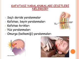 KAFATASI YARALANMALARI ÇEŞİTLERİ
NELERDİR?
 Saçlı deride yaralanmalar
 Kafatası, beyin yaralanmaları
 Kafatası kırıkları
 Yüz yaralanmaları
 Omurga (belkemiği) yaralanmaları
 