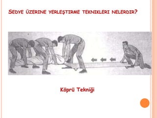 SEDYE ÜZERINE YERLEŞTIRME TEKNIKLERI NELERDIR?
Köprü Tekniği
 