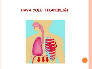 HAVA YOLU TIKANIKLIĞI
 