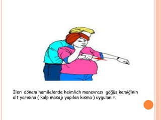 İleri dönem hamilelerde heimlich manevrası göğüs kemiğinin
alt yarısına ( kalp masajı yapılan kısma ) uygulanır.
 