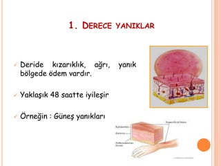 1. DERECE YANIKLAR
 Deride kızarıklık, ağrı, yanık
bölgede ödem vardır.
 Yaklaşık 48 saatte iyileşir
 Örneğin : Güneş yanıkları
 