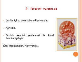 2. DERECE YANIKLAR
 Deride içi su dolu kabarcıklar vardır.
 Ağrılıdır.
 Derinin kendini yenilemesi ile kendi
Kendine iyileşir.
Örn. Haşlanmalar, Alev yanığı…
 