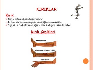 KIRIKLAR
Kırık
Kemik bütünlüğünün bozulmasıdır.
Kırıklar darbe sonucu yada kendiliğinden oluşabilir.
Yaşlılık ile birlikte kendiliğinden kırık oluşma riski de artar.
Kırık Çeşitleri
 