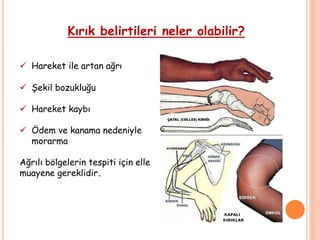 Kırık belirtileri neler olabilir?
 Hareket ile artan ağrı
 Şekil bozukluğu
 Hareket kaybı
 Ödem ve kanama nedeniyle
morarma
Ağrılı bölgelerin tespiti için elle
muayene gereklidir.
 