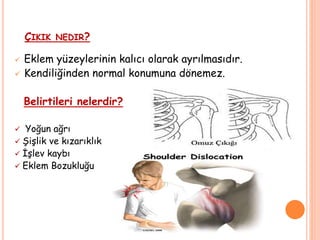 ÇIKIK NEDIR?
 Eklem yüzeylerinin kalıcı olarak ayrılmasıdır.
 Kendiliğinden normal konumuna dönemez.
Belirtileri nelerdir?
 Yoğun ağrı
 Şişlik ve kızarıklık
 İşlev kaybı
 Eklem Bozukluğu
 