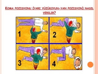 KOMA POZISYONU (YARI YÜZÜKOYUN-YAN POZISYON) NASIL
VERILIR?
 