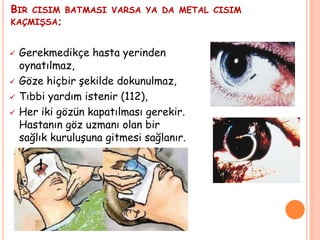 BIR CISIM BATMASI VARSA YA DA METAL CISIM
KAÇMIŞSA;
 Gerekmedikçe hasta yerinden
oynatılmaz,
 Göze hiçbir şekilde dokunulmaz,
 Tıbbi yardım istenir (112),
 Her iki gözün kapatılması gerekir.
Hastanın göz uzmanı olan bir
sağlık kuruluşuna gitmesi sağlanır.
 
