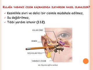 KULAĞA YABANCI CISIM KAÇMASINDA ILKYARDIM NASIL OLMALIDIR?
 Kesinlikle sivri ve delici bir cisimle müdahale edilmez,
 Su değdirilmez,
 Tıbbi yardım istenir (112).
 