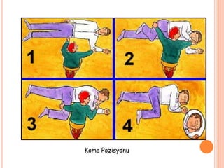 Koma Pozisyonu
 