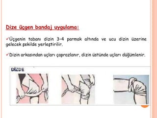 Dize üçgen bandaj uygulama:
Üçgenin tabanı dizin 3–4 parmak altında ve ucu dizin üzerine
gelecek şekilde yerleştirilir.
Dizin arkasından uçları çaprazlanır, dizin üstünde uçları düğümlenir.
 