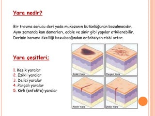 Yara nedir?
Bir travma sonucu deri yada mukozanın bütünlüğünün bozulmasıdır.
Aynı zamanda kan damarları, adale ve sinir gibi yapılar etkilenebilir.
Derinin koruma özelliği bozulacağından enfeksiyon riski artar.
Yara çeşitleri;
1. Kesik yaralar
2. Ezikli yaralar
3. Delici yaralar
4. Parçalı yaralar
5. Kirli (enfekte) yaralar
 