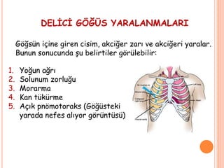 DELİCİ GÖĞÜS YARALANMALARI
Göğsün içine giren cisim, akciğer zarı ve akciğeri yaralar.
Bunun sonucunda şu belirtiler görülebilir:
1. Yoğun ağrı
2. Solunum zorluğu
3. Morarma
4. Kan tükürme
5. Açık pnömotoraks (Göğüsteki
yarada nefes alıyor görüntüsü)
 