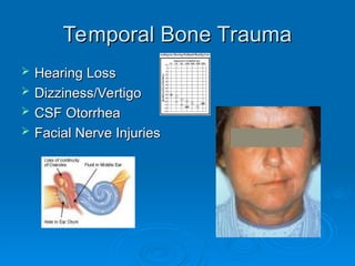 Temporal Bone Trauma
Temporal Bone Trauma
 Hearing Loss
Hearing Loss
 Dizziness/Vertigo
Dizziness/Vertigo
 CSF Otorrhea
CSF Otorrhea
 Facial Nerve Injuries
Facial Nerve Injuries
 